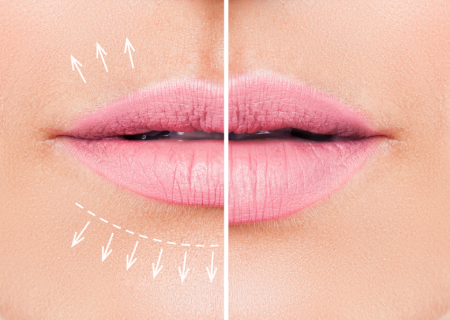 What is a Lip Filler? 